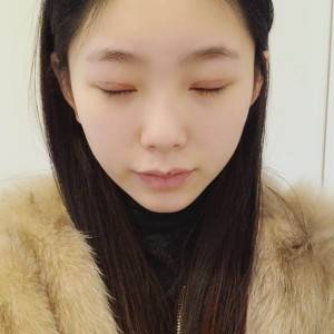 鄭州安格潤整形醫(yī)生楊曉紅做雙眼皮手術(shù)怎么樣？附案例效果圖
