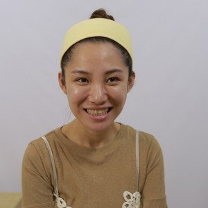 保定東陽口腔醫(yī)院醫(yī)生白小青做牙齒冷光美白怎么樣？附案例效果對(duì)比圖