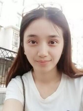 長治松禾醫(yī)療美容診所醫(yī)生馬俊峰做韓式微創(chuàng)定點雙眼皮效果怎么樣？附案例