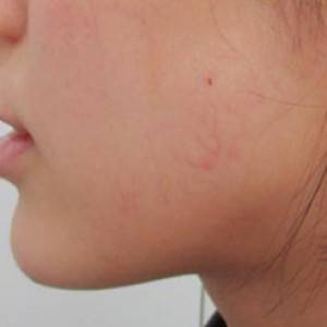 蚌埠韓美美萊整形醫(yī)院醫(yī)生張濤做玻尿酸墊下巴怎么樣？來看案例效果圖