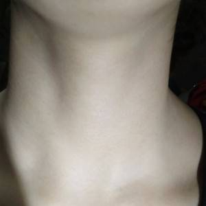 昭通愛麗諾整形醫(yī)生陳志江做嗨體去頸紋怎么樣？附案例效果圖