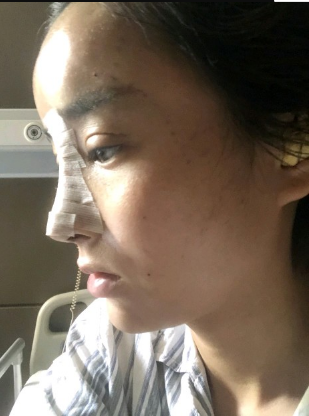 武漢米蘭醫(yī)療美容醫(yī)生柳再億做眼綜合+鼻綜合整形怎么樣？附真實(shí)案例對(duì)比圖