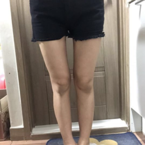 貴陽華美整形美容醫(yī)院醫(yī)生田永華做大腿吸脂效果怎么樣？附大腿吸脂案例前后對比圖