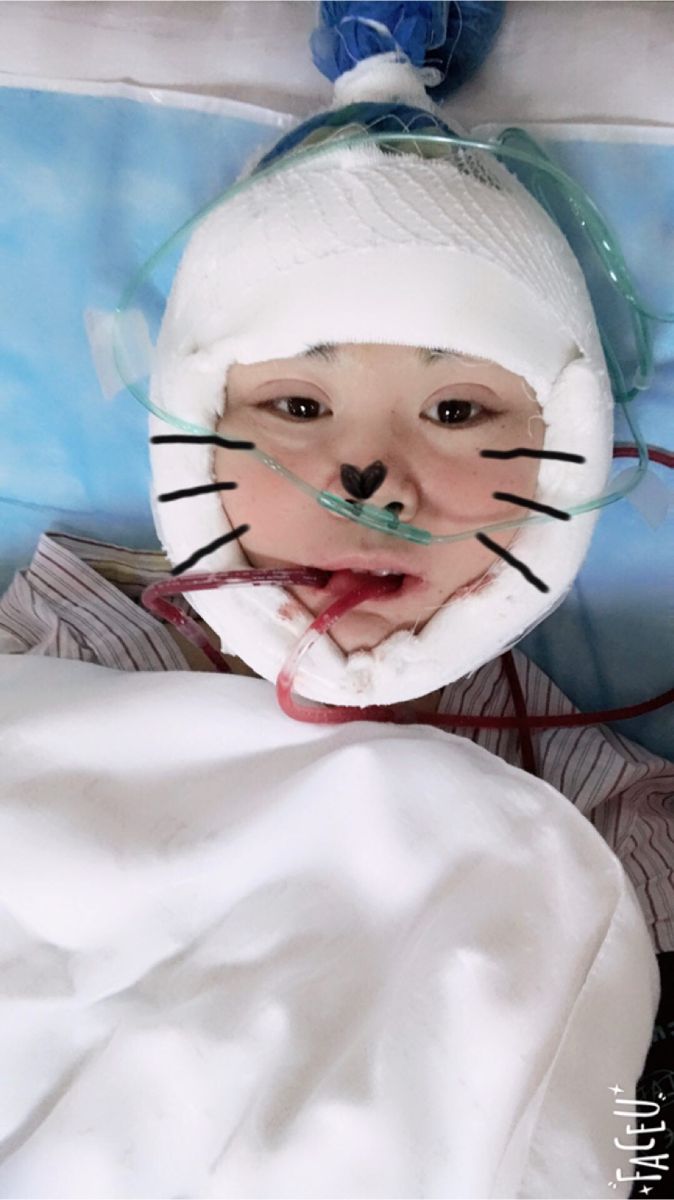 北京彤美美容整形醫(yī)院醫(yī)生楊曉惠做顴骨內(nèi)推+面部吸脂手術(shù)效果怎么樣？附案例