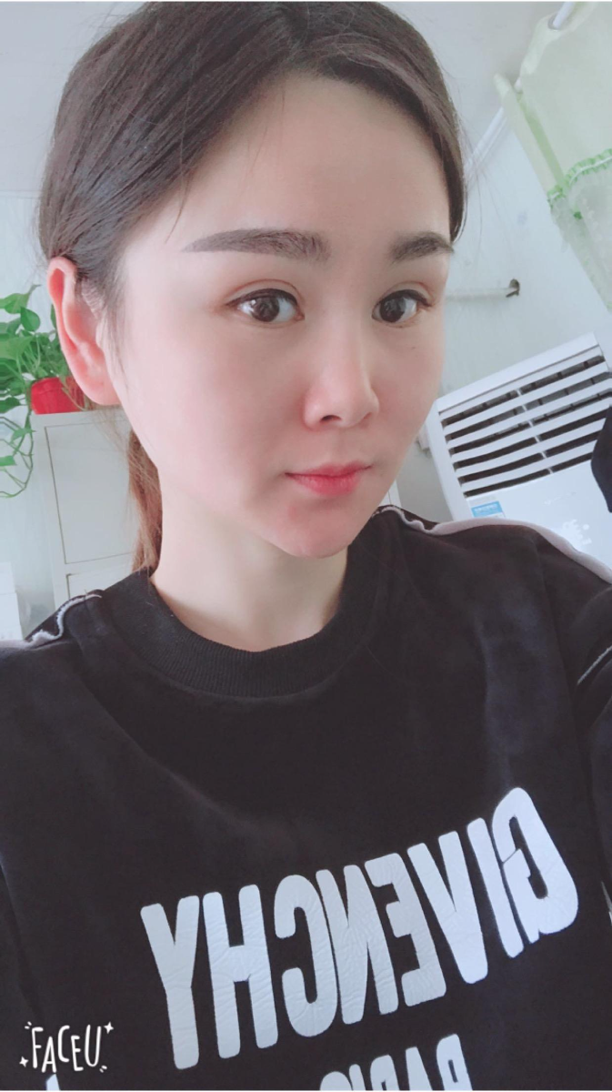 北京彤美美容整形醫(yī)院醫(yī)生楊曉惠做顴骨內(nèi)推+面部吸脂手術(shù)效果怎么樣？附案例