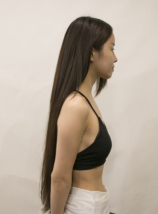 吉林現(xiàn)代整形美容醫(yī)院做假體隆胸效果怎么樣？附醫(yī)院案例效果對(duì)比圖