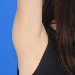 重慶中成整形美容醫(yī)院醫(yī)生田忠成激光脫腋毛效果怎么樣？附案例效果圖