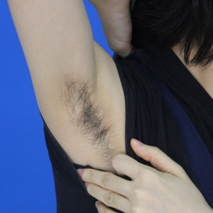 重慶中成整形美容醫(yī)院醫(yī)生田忠成激光脫腋毛效果怎么樣？附案例效果圖