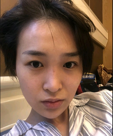 武漢米蘭醫(yī)療美容醫(yī)生柳再億做眼綜合+鼻綜合整形怎么樣？附真實案例對比圖