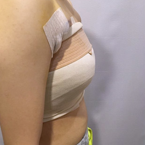 河南協(xié)和醫(yī)院整形外科醫(yī)生騰利做自體脂肪隆胸怎么樣？附案例效果對(duì)比圖