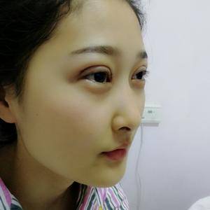 周口垣夢醫(yī)療整形醫(yī)生王濤做切開雙眼皮怎么樣？附切開雙眼皮案例效果對比圖