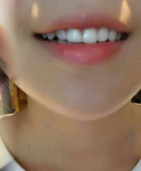 淄博口腔醫(yī)院醫(yī)生牟象鑫做超聲波洗牙怎么樣？附案例效果對比圖