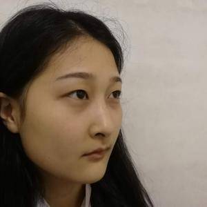 周口垣夢醫(yī)療整形醫(yī)生王濤做切開雙眼皮怎么樣？附切開雙眼皮案例效果對比圖