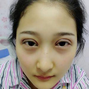 周口垣夢醫(yī)療整形醫(yī)生王濤做切開雙眼皮怎么樣？附切開雙眼皮案例效果對比圖