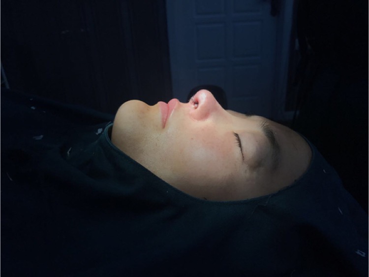 北京集美名媛醫(yī)療整形醫(yī)生陳瀅雯做自體耳軟骨隆鼻怎么樣？附案例效果圖