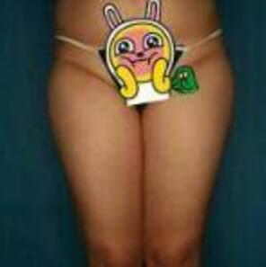 貴陽(yáng)華美整形美容醫(yī)院醫(yī)生田永華做大腿吸脂效果怎么樣？附大腿吸脂案例前后對(duì)比圖