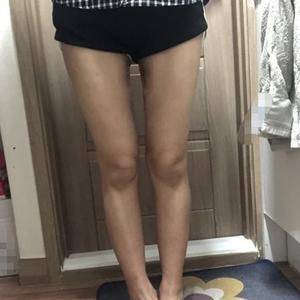 貴陽華美整形美容醫(yī)院醫(yī)生田永華做大腿吸脂效果怎么樣？附大腿吸脂案例前后對比圖