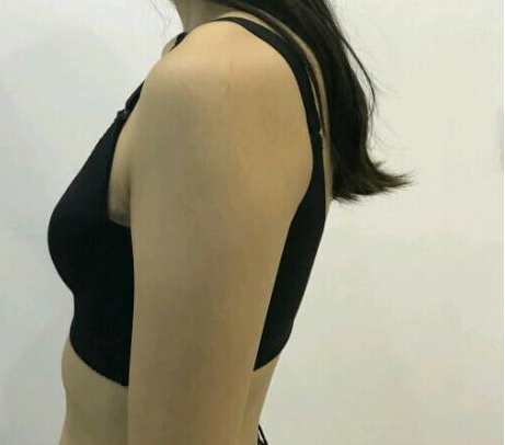 武漢伽美醫(yī)療美容醫(yī)院醫(yī)生朱富初做自體脂肪隆胸怎么樣？看案例