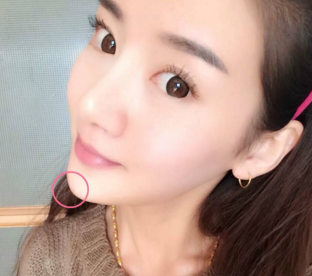洛陽(yáng)愛(ài)尚醫(yī)療美容門(mén)診部假體墊下巴