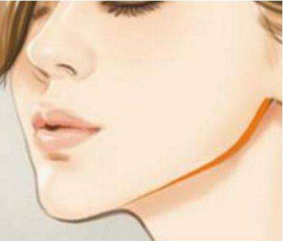 深圳福華中西醫(yī)結(jié)合醫(yī)院醫(yī)學(xué)美容科下頜角整形