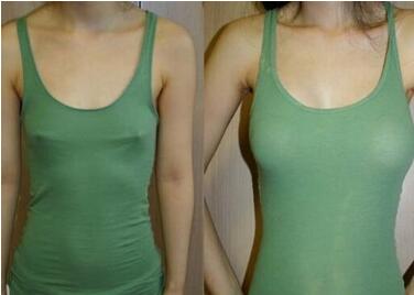 福州麥瑞整形美容醫(yī)院假體隆胸