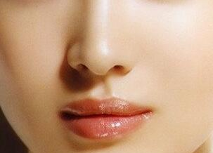 天津維美醫(yī)療美容醫(yī)院鼻小柱延長(zhǎng)