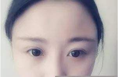 海南華美醫(yī)學(xué)美容醫(yī)院自體脂肪豐太陽(yáng)穴