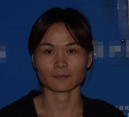 上海時(shí)光整形醫(yī)生何晉龍做下頜角磨骨術(shù)前術(shù)后案例效果對(duì)比圖