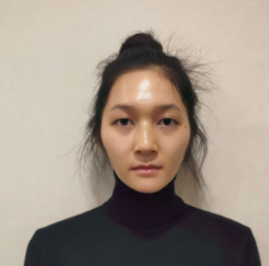 上海時(shí)光整形醫(yī)院做面部玻尿酸注射效果怎么樣？