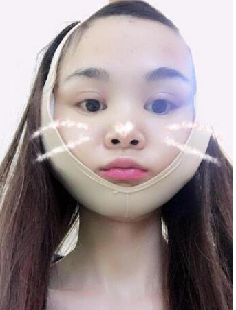 上海時(shí)光整形醫(yī)生何晉龍做下頜角磨骨術(shù)前術(shù)后案例效果對(duì)比圖