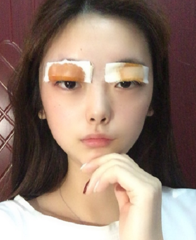 合肥韓美整形醫(yī)院做雙眼皮效果怎么樣?附石顯武醫(yī)生案例