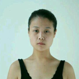 合肥韓美整形醫(yī)院做隆鼻手術(shù)效果怎么樣?附劉冷醫(yī)生隆鼻案例效果圖 合肥韓美整形醫(yī)院做隆鼻手術(shù)效果怎么樣?附劉冷醫(yī)生隆鼻案例效果圖