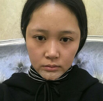 上海時(shí)光整形醫(yī)院做豐下巴怎么樣？許黎平醫(yī)生豐下巴案例分享