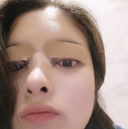 合肥韓美整形醫(yī)院做雙眼皮+開(kāi)眼角效果怎么樣?附石顯武醫(yī)生真實(shí)案例效果圖 合肥韓美整形醫(yī)院做雙眼皮+開(kāi)眼角效果怎么樣?附石顯武醫(yī)生真實(shí)案例效果圖