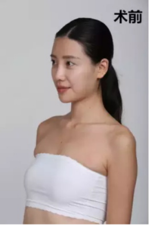 上海時(shí)光整形醫(yī)院何晉龍醫(yī)生做假體隆胸怎么樣？附案例對(duì)比圖