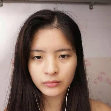 合肥韓美整形醫(yī)院做雙眼皮+開(kāi)眼角效果怎么樣?附石顯武醫(yī)生真實(shí)案例效果圖 合肥韓美整形醫(yī)院做雙眼皮+開(kāi)眼角效果怎么樣?附石顯武醫(yī)生真實(shí)案例效果圖