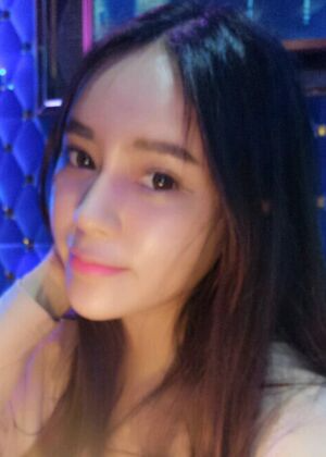 鞍山王景醫(yī)療美容外科診所做自體脂肪豐蘋(píng)果肌效果怎么樣？附張婉鸝案例效果圖