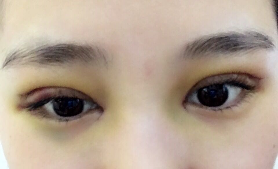 蚌埠韓美美萊整形醫(yī)生鄭捷做開眼角怎么樣？附案例效果圖