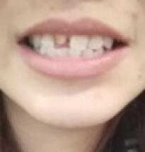 鞍山時(shí)代口腔門(mén)診部劉昕醫(yī)生做美容冠效果怎么樣？一起來(lái)看看吧