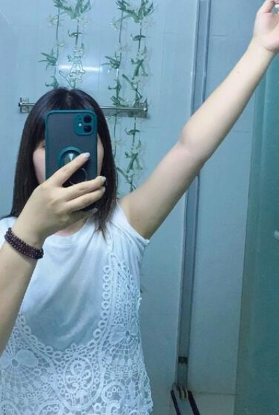 蚌埠市第三人民醫(yī)院燒傷整形科楊蔚做手臂吸脂效果對比圖