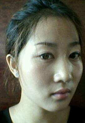 鞍山菲之都整形醫(yī)生李宗亮做字體脂肪豐太陽(yáng)穴效果怎么樣？附案例效果對(duì)比圖