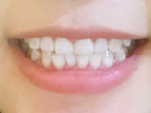 安慶渡江口腔醫(yī)院張良斌醫(yī)生做超聲波洗牙效果怎么樣？附洗牙案例效果圖