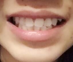 鞍山時(shí)代口腔門診部劉昕醫(yī)生做美容冠效果怎么樣？一起來看看吧