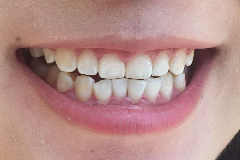 安慶渡江口腔醫(yī)院張良斌醫(yī)生做超聲波洗牙效果怎么樣？附洗牙案例效果圖