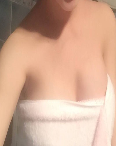 安慶市立醫(yī)院整形外科華棟醫(yī)生做自體脂肪隆胸效果怎么樣？附真實案例圖