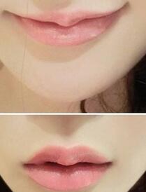 巴中時光醫(yī)學美容門診部做玻尿酸豐唇效果怎么樣？附李紅強豐唇案例