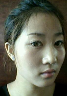 鞍山菲之都整形醫(yī)生李宗亮做字體脂肪豐太陽穴效果怎么樣？附案例效果對比圖