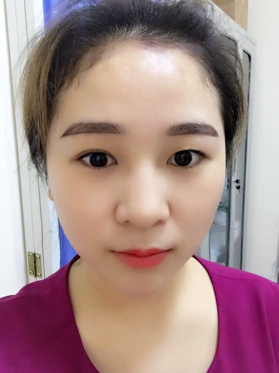 蚌埠韓美美萊整形醫(yī)生鄭捷做開(kāi)眼角怎么樣？附案例效果圖