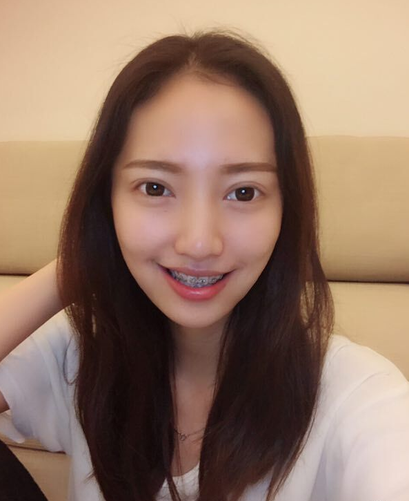 巴中華醫(yī)口腔醫(yī)院做牙齒矯正效果好嗎？附母汶靈醫(yī)生牙齒矯正案例效果圖