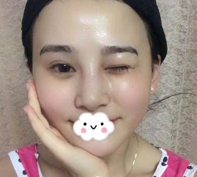 蚌埠韓美美萊整形醫(yī)生歷芳做耳軟骨隆鼻怎么樣？附耳軟骨隆鼻案例對(duì)比圖